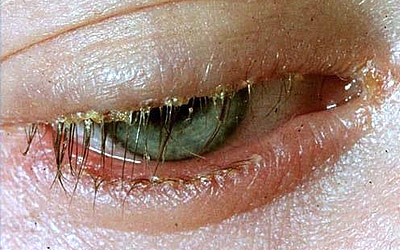 Closeup of an eye with blepharitis