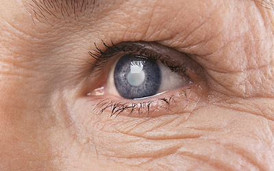 Closeup of an eye with a cataract