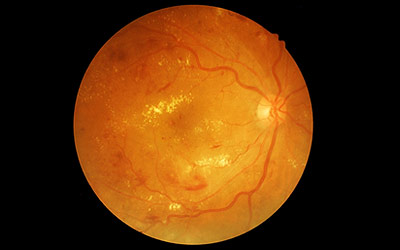 Scan of an eye with diabetic retinopathy