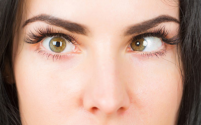 Closeup of a woman with strabismus