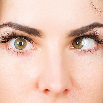 Closeup of a woman with a misaligned eye