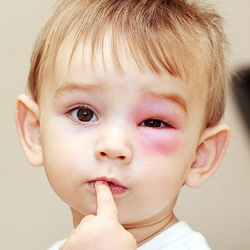 Closeup of child with a swollen eye