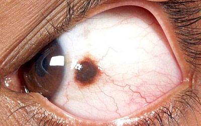 Closeup of an eye lesion