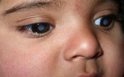Closeup of a child with cataracts