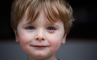 Child with a chalazion