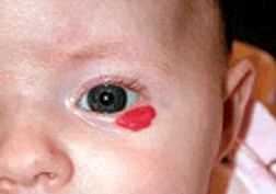 Capillary Hemangioma 