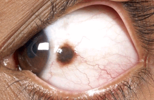 Conjunctival Nevus