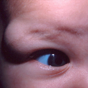 Dermoid