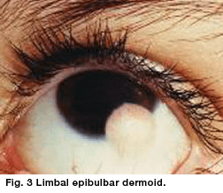 Limbal Dermoid
