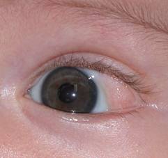 Lipodermoid