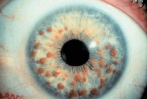 Lisch Nodule