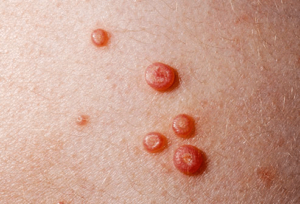Molluscum Contagiosum