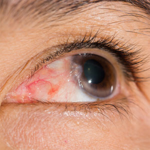 Eye with Pterygium