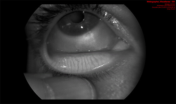 Dry Eye picture