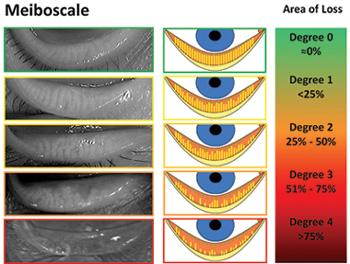 Meiboscale Area of Loss