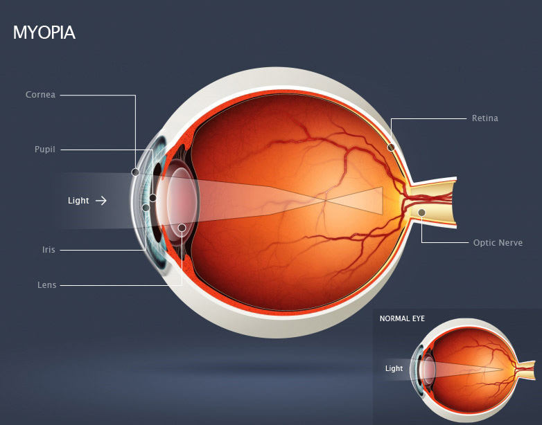 Myopia diagram