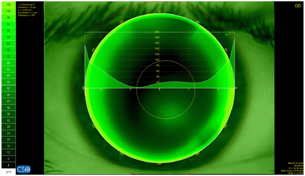 Contact Lens Auto-Fit