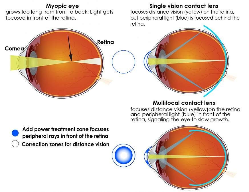 Myopic Eye vs Single vision contact lens
