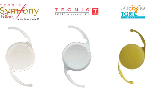 Toric Lens Implant