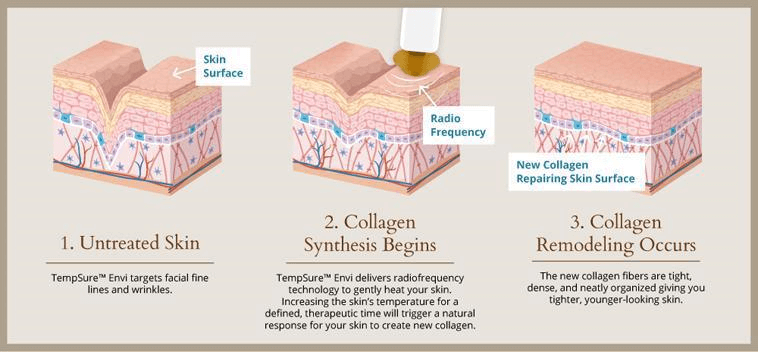 TempSure Envi step-by-step