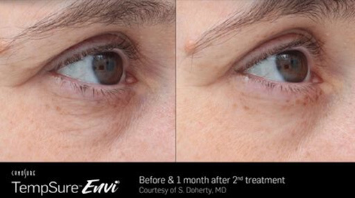 TempSure Envi Before & After