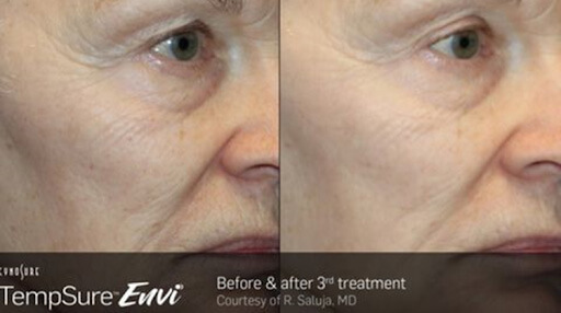 TempSure Envi Before & After 3rd Treatment